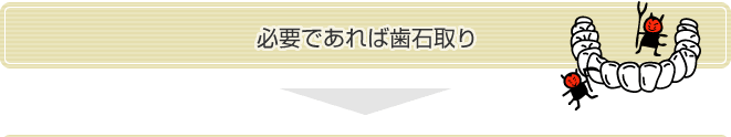 必要であれば歯石取り